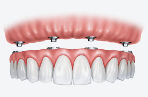 Full Mouth Restoration