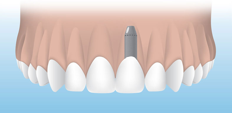 Dental Implant Graphic