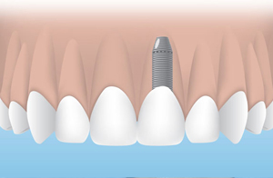 dental-implants-grapevine
