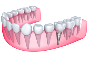 dental implants irving
