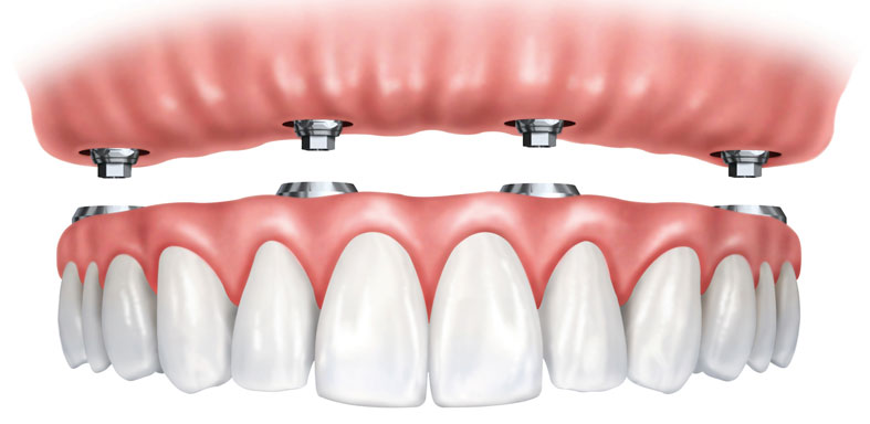 implant supported dentures grapevine tx