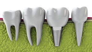 dental implants Keller