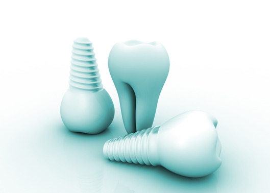 dental implants Irving TX