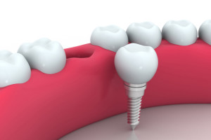 dental implants Irving TX